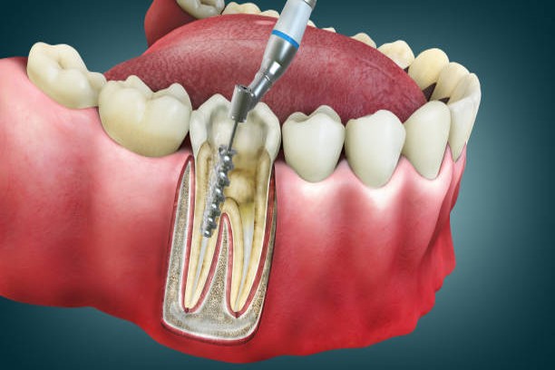 Root-canal-treatment-new-1-1
